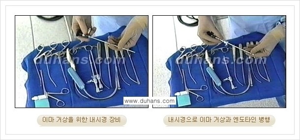 [두한성형외과 경쟁력 주름성형] - [엔도타인 리프팅 안내 ②] 관련 이미지 7