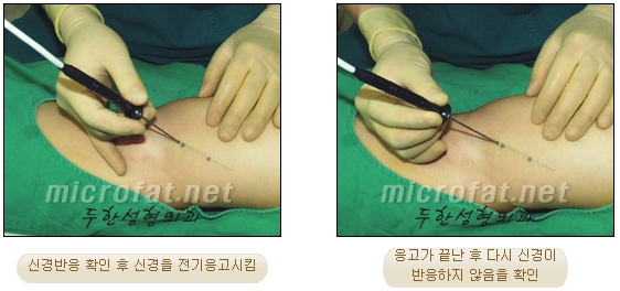 [Duhan Plastic Surgery Clinic Calf Contouring] - [Calf Reduction] image 13