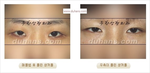 [두한성형외과 경쟁력 눈성형] - [풀려버린 쌍꺼풀 교정 방법] 관련 이미지 1