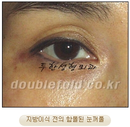 [두한성형외과 쌍수] - [재수술 실패의 원인, 재수술의 성공 요건] 관련 이미지 15