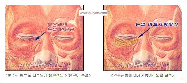 [두한성형외과 경쟁력 눈밑성형] - [눈밑 다크써클 수술 방법] 관련 이미지 4