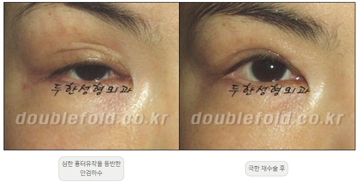 [Double Eyelid Surgery, Duhan Plastic Surgery] - [Extreme Revision Eye Surgery to Correct a Damaged Line] image 20