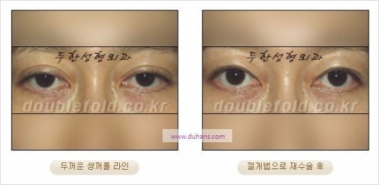 [두한성형외과 경쟁력 눈성형] - [쌍꺼풀 재수술에 대한 최선의 대안 제시] 관련 이미지 13