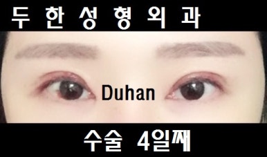[두한성형외과 쌍커풀재수술] - [심한 소세지눈, 두줄따기, 쌍꺼풀 흉터] 관련 이미지 38