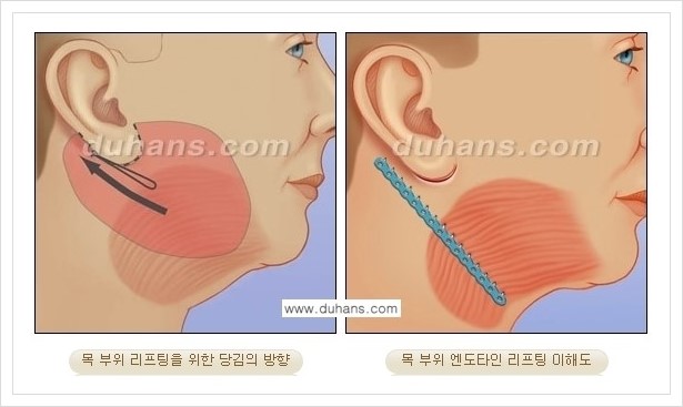 [두한성형외과 경쟁력 주름교정술] - [엔도타인 리프팅 안내 ②] 관련 이미지 3