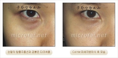두한성형외과 눈밑수술 - 다크서클 수술 전후 관리 안내 관련 이미지 26