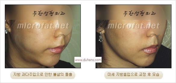[두한성형외과 경쟁력 윤곽성형] - [볼, 볼살 지방이식] 관련 이미지 40