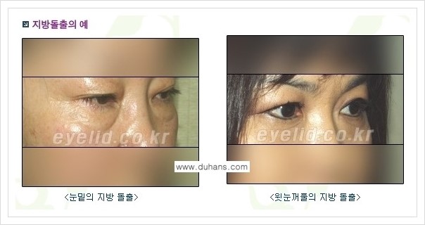 [두한성형외과 경쟁력 눈성형] - [윗눈꺼풀 지방제거 방법 안내] 관련 이미지 1