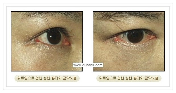 [두한성형외과 경쟁력 쌍꺼풀 재수술, 극한 재수술] - [뒤트임 수술에 대한 안내] 관련 이미지 1