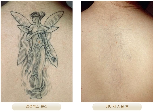 Duhan Plastic Surgery Laser Treatment - Mole Removal, Spot Removal, Melasma, Blemishes, Hyperpigmentation, Skin Tone Improvement, Elasticity Improvement, Skin Texture Improvement image 28