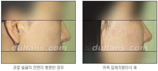 [두한성형외과 얼굴자가지방이식] - [귀족수술 입체 미세지방이식] 관련 이미지 12