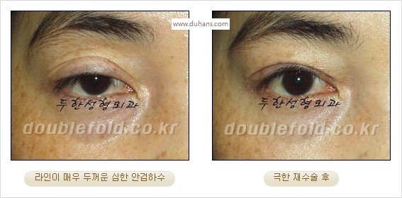 [두한성형외과 경쟁력 쌍꺼풀 재수술 스페셜] - [망가진 라인을 교정하는 극한 재수술] 관련 이미지 15
