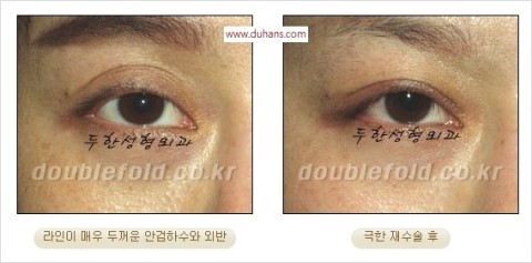 ​[두한성형외과 눈재수술] - [앞트임복원, 뒤트임복원, 쌍꺼풀복원] 관련 이미지 41