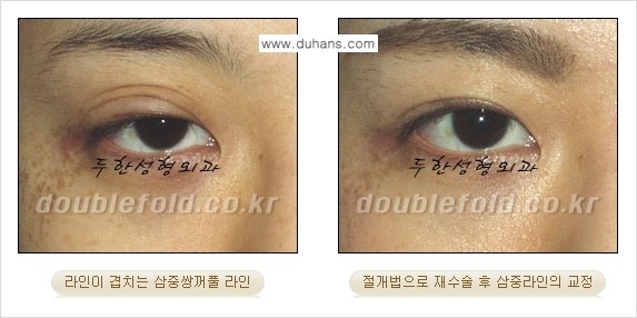 ⁠[두한성형외과 경쟁력 쌍꺼풀 재수술, 극한 눈재수술] - [삼중(세겹) 쌍꺼풀 라인의 교정] 관련 이미지 9