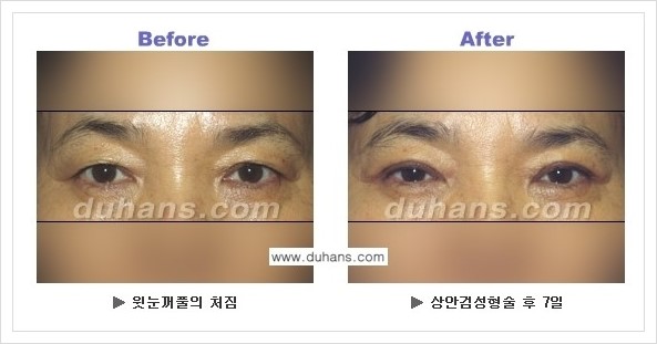 [두한성형외과 경쟁력 눈성형] - [상큼하고 환한 젊은 눈매 상안검성형(윗눈꺼풀 처짐) 안내] 관련 이미지 9