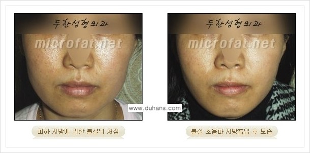 [두한성형외과 겨울엔 지방흡입을] - [볼살, 눈밑, 턱선의 초음파 미세지방흡입 2.] 관련 이미지 6