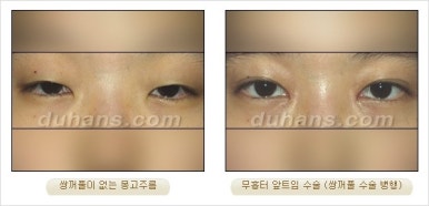 쌍커풀수술 두한성형외과 - 나에게 맞는 눈성형은? 관련 이미지 59
