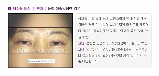 [두한성형외과 경쟁력 쌍꺼풀 재수술(극한 재수술)] - [쌍꺼풀 재수술 대상의 안내] 관련 이미지 2