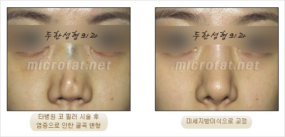 [두한성형외과 경쟁력 지방이식 리더] - [Col-fat(콜펫)지방이식, 3차원 입체지방이식, 2차원 평면지방이식] 관련 이미지 46