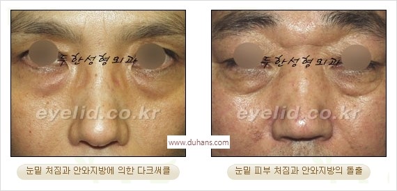 [두한성형외과 경쟁력 안검성형] - [눈밑주름 제거수술] 관련 이미지 1