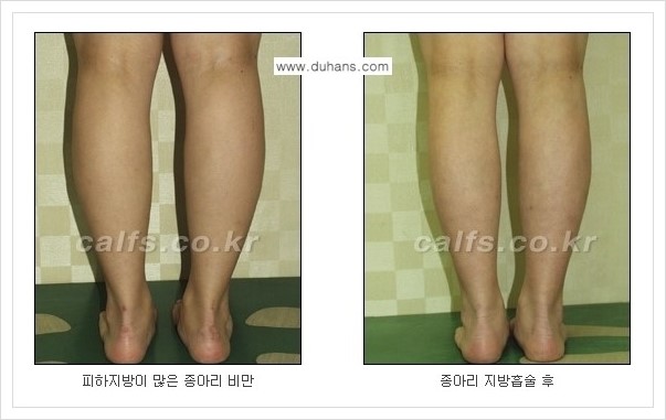 [두한성형외과 경쟁력 멀티종아리성형] - [예쁜 종아리를 만드는 종아리 지방흡입술 안내] 관련 이미지 15