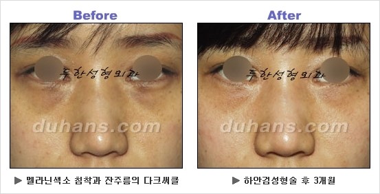 [두한성형외과 경쟁력 동안성형 리더] - ​[미간주름, 이마주름, 안검성형, 이마거상술, 눈썹거상술] 관련 이미지 117