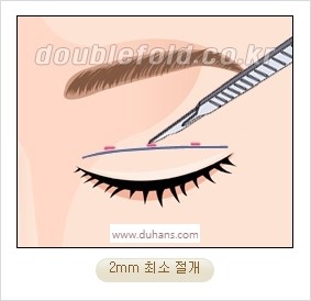 [두한성형외과 경쟁력 눈성형] - [자연스럽고 아름다운 눈매를 만드는 여러 가지 눈성형 방법] 관련 이미지 6
