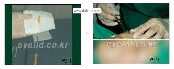[두한성형외과 경쟁력 눈밑성형] - [눈밑 다크써클 수술 방법] 관련 이미지 8