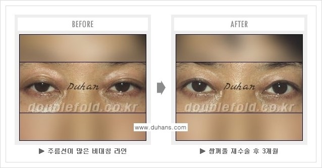 [두한성형외과 경쟁력 쌍꺼풀 재수술, 극한 눈재수술] - [쌍꺼풀 재수술, 극한 눈재수술 관련 자주하는 질문과 답변] 관련 이미지 13