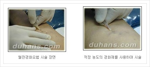 [두한성형외과 경쟁력 정맥류 치료] - [정맥류 치료의 모든 것] 관련 이미지 28