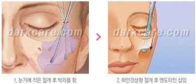 [눈밑수술 두한성형외과] - [다크서클 콤비프로그램] 관련 이미지 151