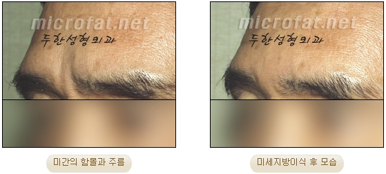 [두한성형외과 자가지방이식] - [미간주름] 관련 이미지 8
