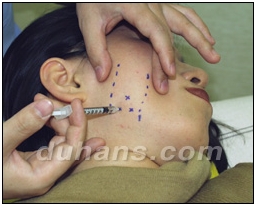 [Duhan Plastic Surgery Clinic Aesthetic Procedures] - [Square Jaw Botox] image 13