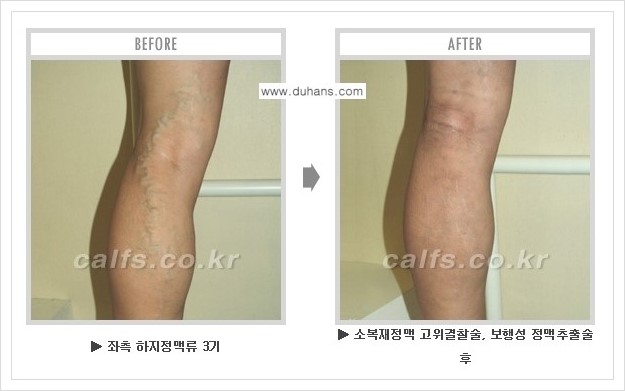 [두한성형외과 경쟁력 멀티종아리성형] - [하지정맥류 치료 안내] 관련 이미지 1