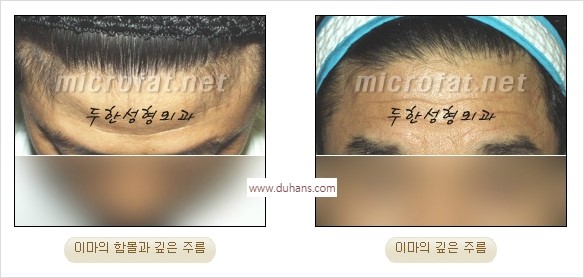 [두한성형외과 경쟁력 동안성형 리더] - ​[미간주름, 이마주름, 안검성형, 이마거상술, 눈썹거상술] 관련 이미지 26