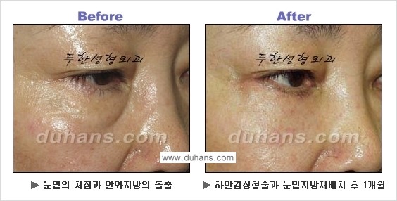 [두한성형외과의 상큼하고 환한 젊은 눈매완성] - [하안검 성형술 ①] 관련 이미지 9