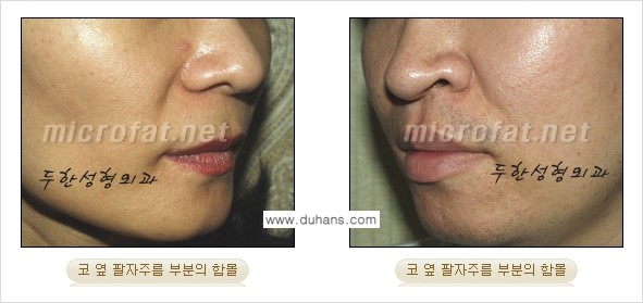 [두한성형외과의 경쟁력 미세지방이식] - [귀족수술과 인디언밴드 미세지방이식 안내 ①] 관련 이미지 3