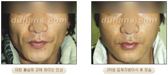 [두한성형외과 얼굴자가지방이식] - [볼살, 이마, 측두부] 관련 이미지 33