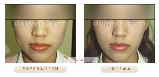 [두한성형외과 경쟁력 안면윤곽성형] - [보톡스(보툴리눔톡신)에 의한 사각턱 교정] 관련 이미지 7