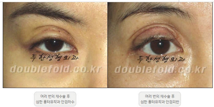 [Double Eyelid Surgery, Duhan Plastic Surgery] - [Extreme Revision Eye Surgery to Correct a Damaged Line] image 2