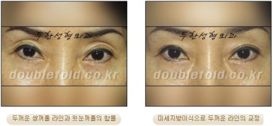 [두한성형외과 쌍커풀수술] - [쌍꺼풀지방이식] 관련 이미지 16