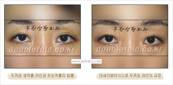 ​⁠⁠[두한성형외과 경쟁력 쌍꺼풀 재수술, 극한 눈재수술] - [지방이식으로 눈매와 쌍꺼풀 라인을 교정] 관련 이미지 11