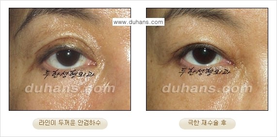[두한성형외과 성형 FOCUS] - [정상적인 눈매로의 복원 극한재수술 경우 ②] 관련 이미지 5