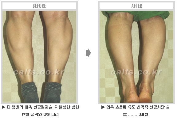 [종아리성형 두한성형외과] - [종아리수술에 대한 자주하는 질문과 답변 모음] 관련 이미지 66