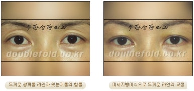 [Duhan Plastic Surgery Revision Double Eyelid Surgery] - [Double Eyelid Revision Surgery Process] image 40