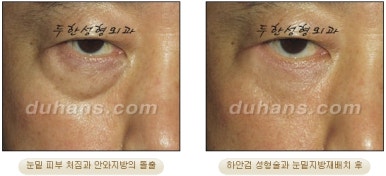 Blepharoplasty, Duhan Plastic Surgery - Upper and Lower Eyelids image 27