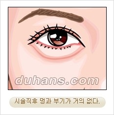 ⁠⁠[두한성형외과 경쟁력 안검성형] - [젊은 눈매를 위한 윗눈꺼풀 지방제거, 눈밑 지방제거] 관련 이미지 19