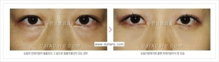 [두한성형외과 경쟁력 다크써클 교정] - [눈밑 돌출이 있으면서 그 아래 함몰 주름선이 있는 증상 개선 방법 안내] 관련 이미지 2