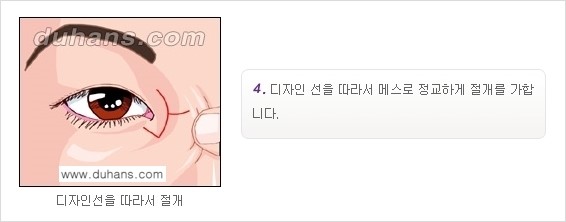 [두한성형외과 NO.1 눈성형] - [몽고주름 제거(앞트임 수술) 2.] 관련 이미지 5