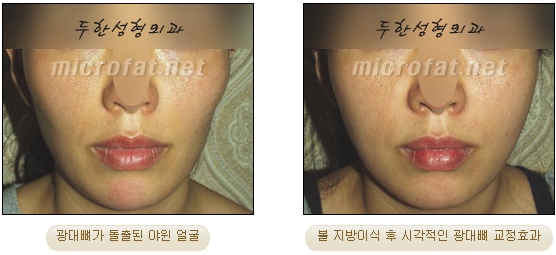 얼굴지방이식 두한성형외과 - 볼지방이식 관련 이미지 19